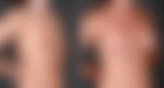 Breast Augmentation Before and After Photos in Omaha, NE, Case 4975