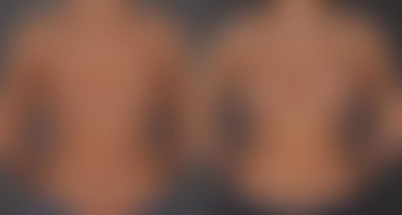 Breast Augmentation Before and After Photos in Omaha, NE, Case 8764