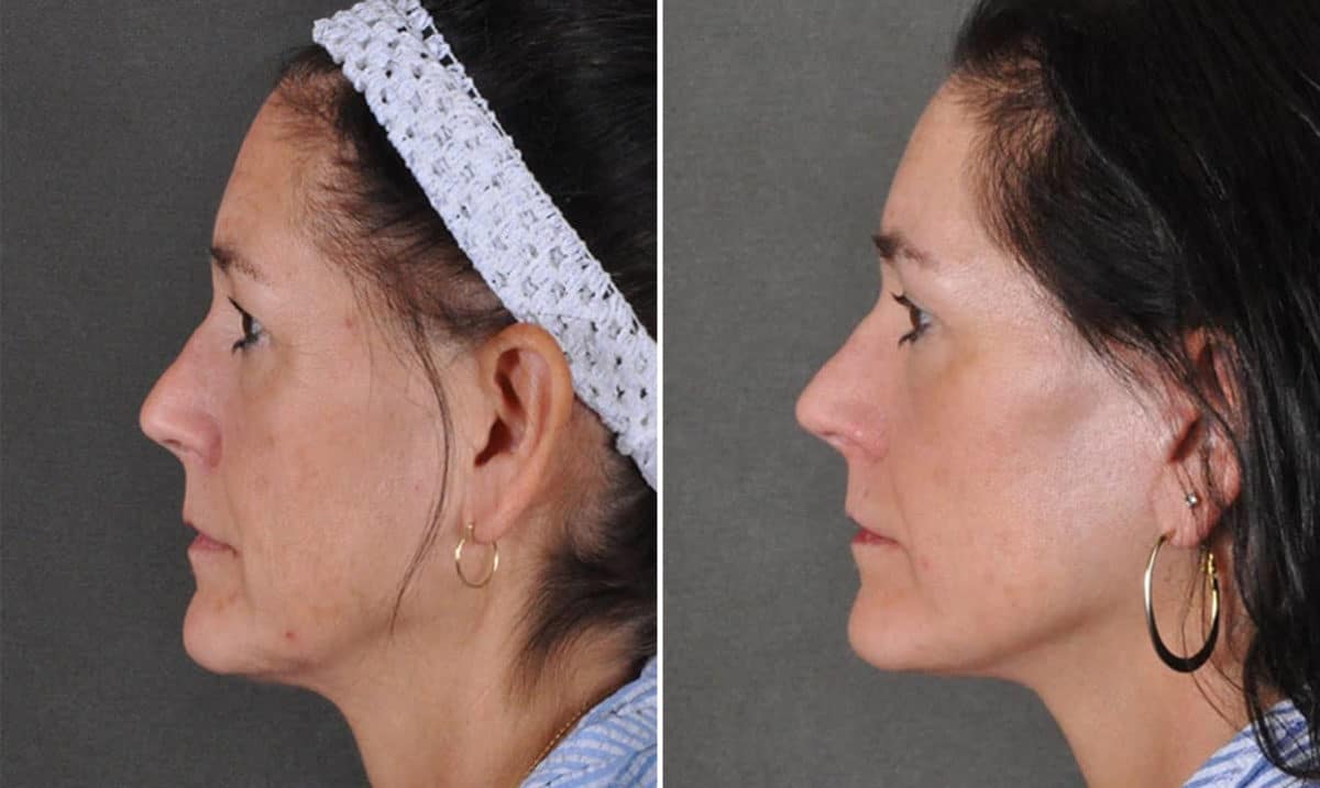 Brow Lift Before and After Photos in Omaha, NE, Case 16912