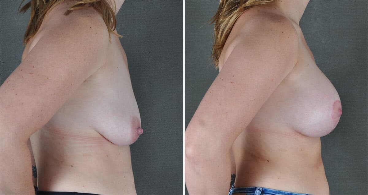 Breast Augmentation Before and After Photos in Omaha, NE, Case 21199