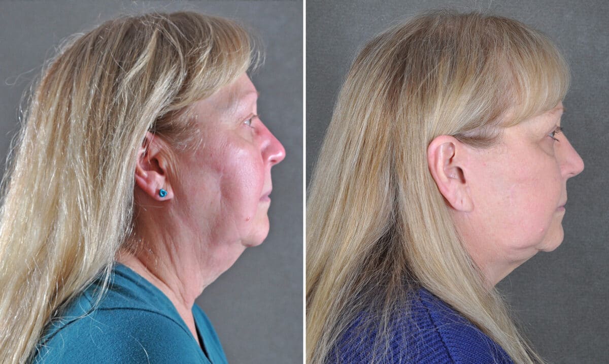 Facelift Before and After Photos in Omaha, NE, Case 21654