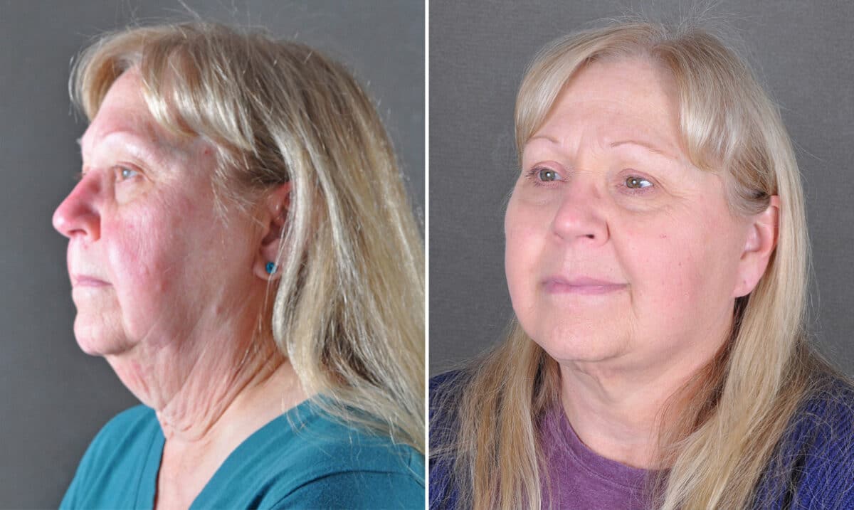 Blepharoplasty Before and After Photos in Omaha, NE, Case 21680