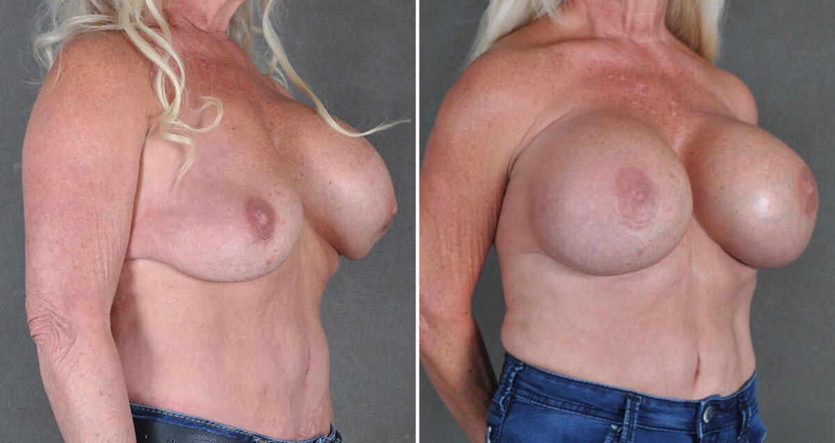 Breast Augmentation Before and After Photos in Omaha, NE, Case 22084